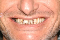 veneers