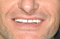 veneers