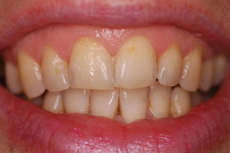 tooth-whitening-before