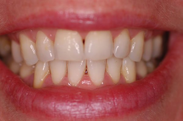 tooth-whitening-after